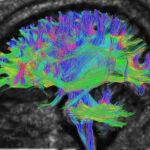 MRI Tractography