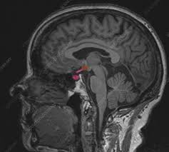 MRI Brain With Pituitary