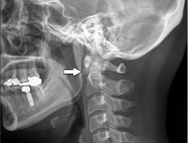 X-Ray Styloid Processes