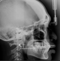 X-ray TM Joint (MC)