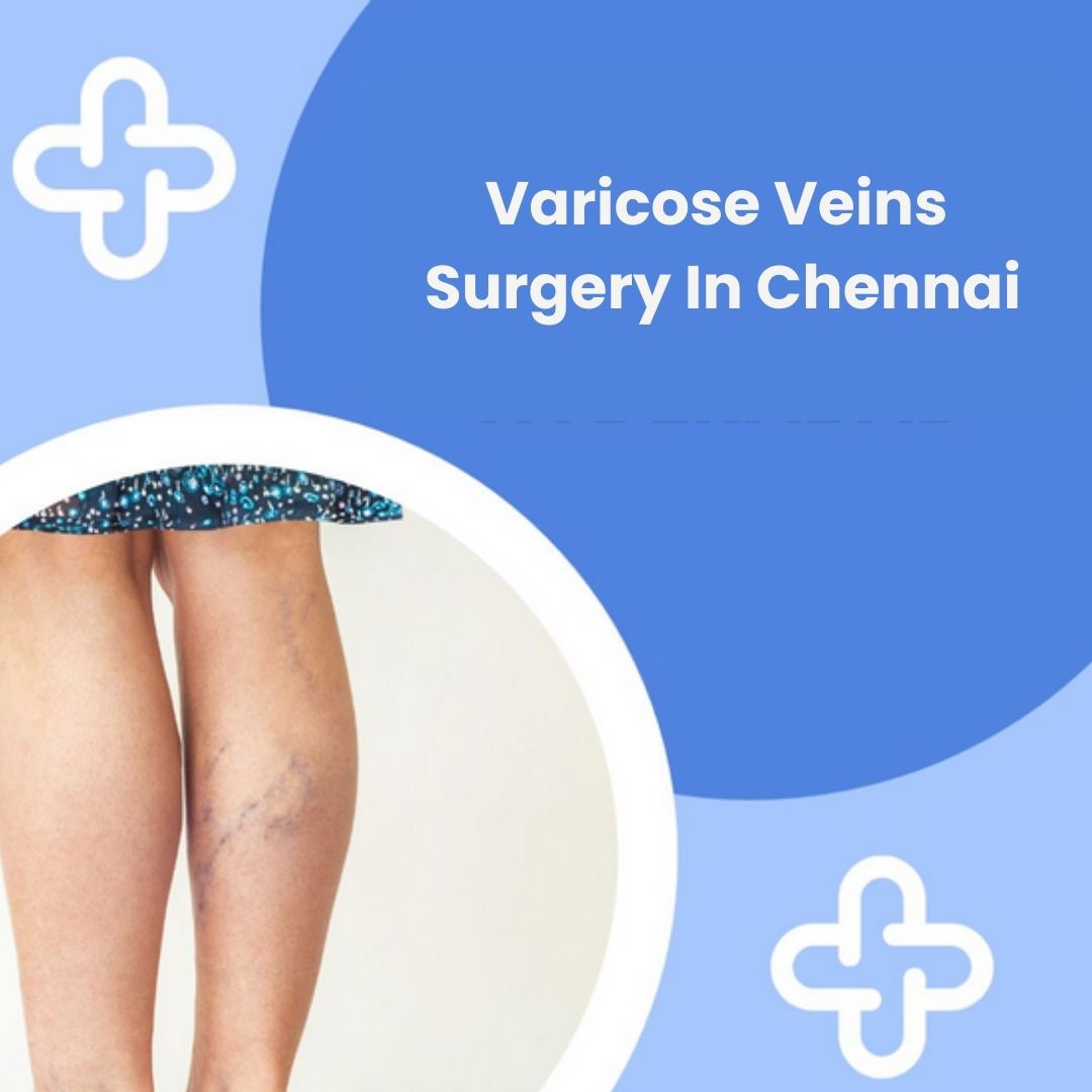 Varicose Veins Surgery in Chennai