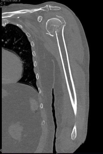 Ct Scan Humerus