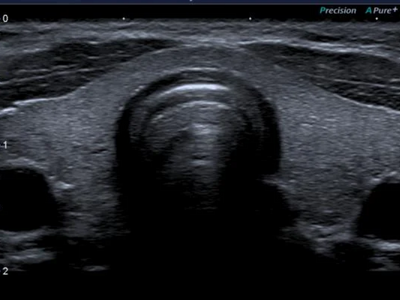ultrasound Scan for Thyroid