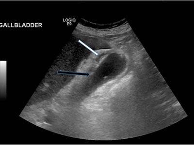 Gallbladder ultrasound